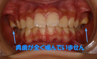 鋏状咬合(すれ違い咬合)