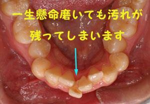 叢生(乱ぐい歯)