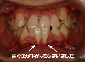 受け口(前歯の反対咬合)