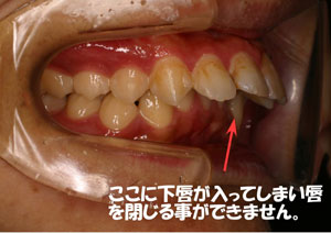 上顎前突(出っ歯)