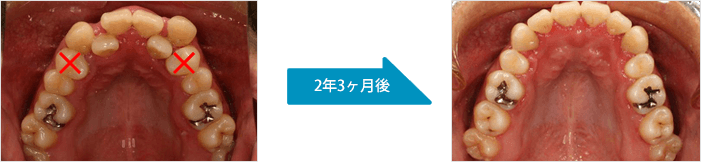 2年3ヶ月後