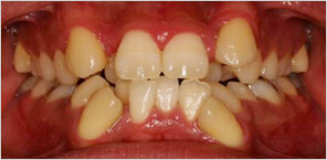 叢生（八重歯・乱ぐい歯）の様子